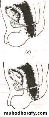 SURGERY OF THE ANAL CANAL