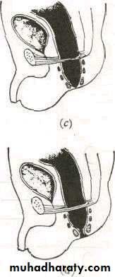 SURGERY OF THE ANAL CANAL