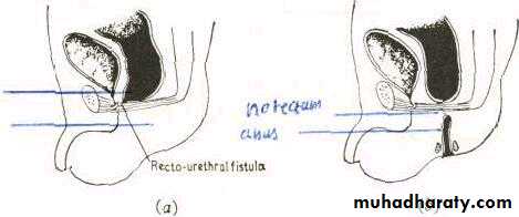 SURGERY OF THE ANAL CANAL