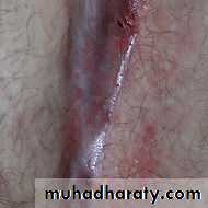 SURGERY OF THE ANAL CANAL