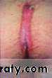 SURGERY OF THE ANAL CANAL