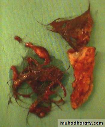 SURGERY OF THE ANAL CANAL