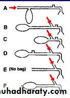 Breathing Circuits In Anaesthesia