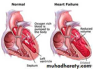heart failure