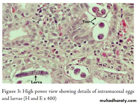 Strongyloides stercoralis