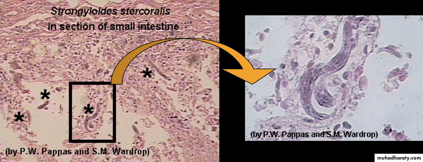 Strongyloides stercoralis