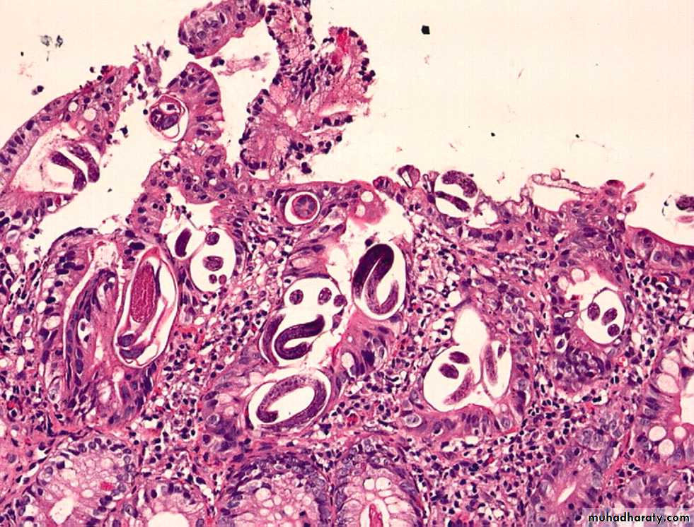 Strongyloides stercoralis