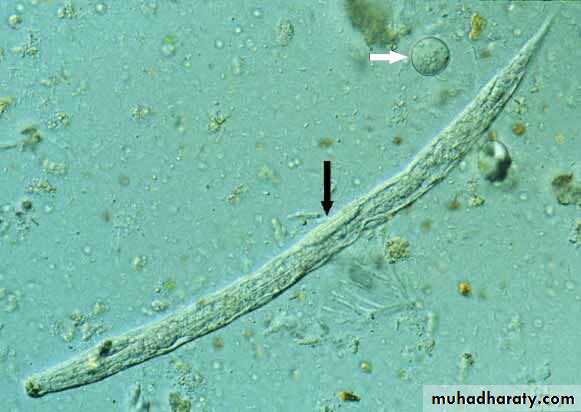 Strongyloides stercoralis