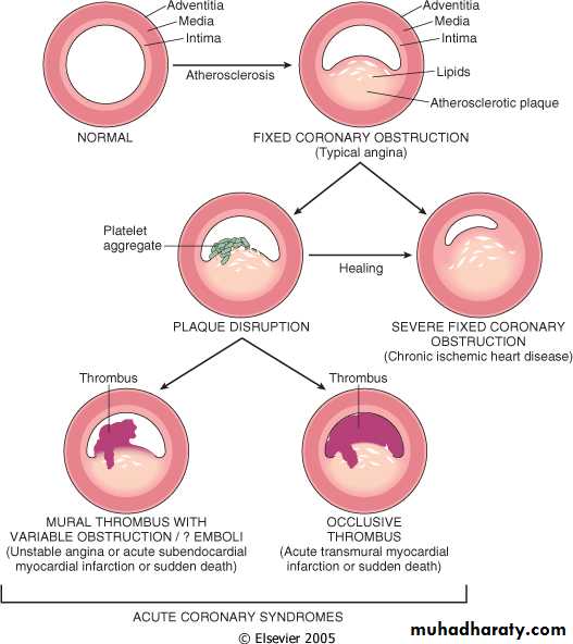 Heart Diseases