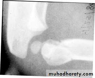 supracondyler تأشيرات