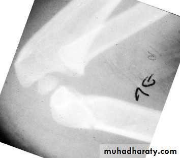 supracondyler تأشيرات