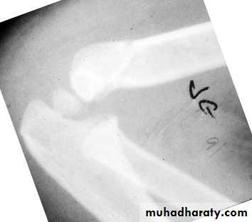 supracondyler تأشيرات