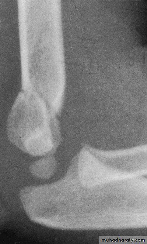 supracondyler تأشيرات
