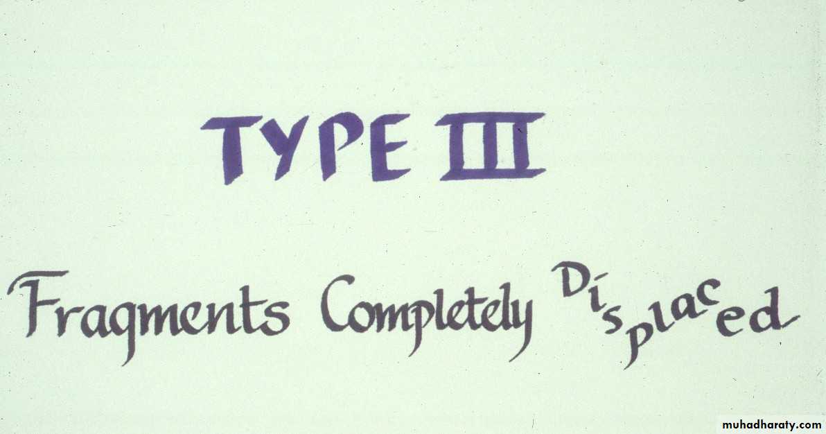 supracondyler تأشيرات