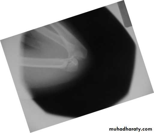 supracondyler تأشيرات