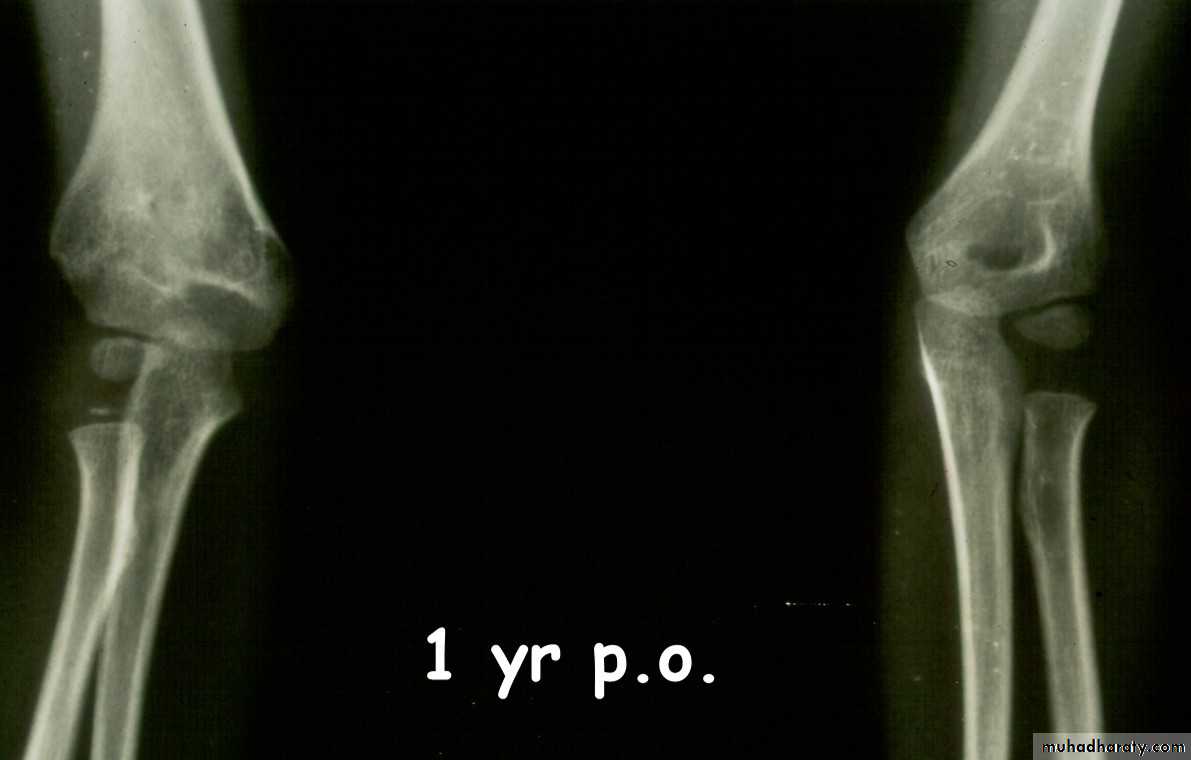 supracondyler تأشيرات