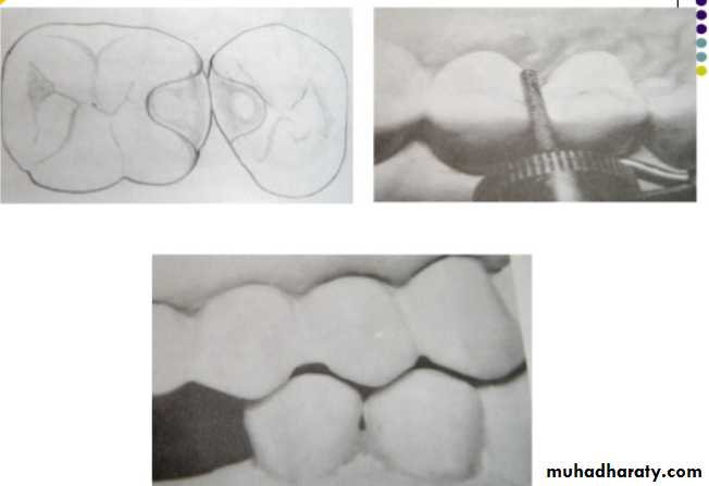mouth preparation for removable partial denture