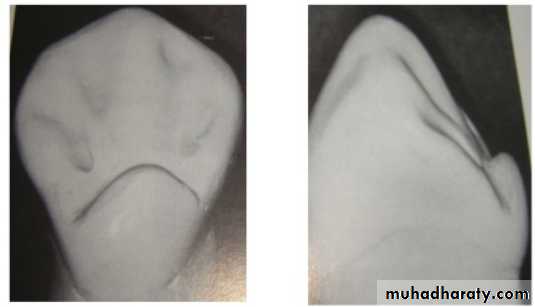 mouth preparation for removable partial denture