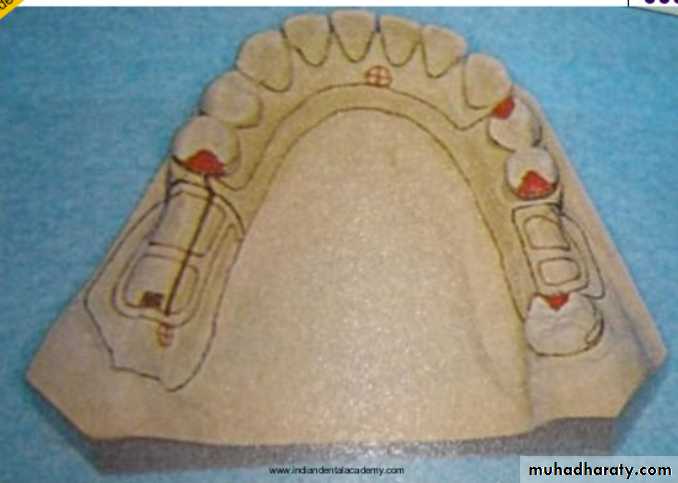 mouth preparation for removable partial denture