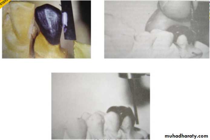 mouth preparation for removable partial denture
