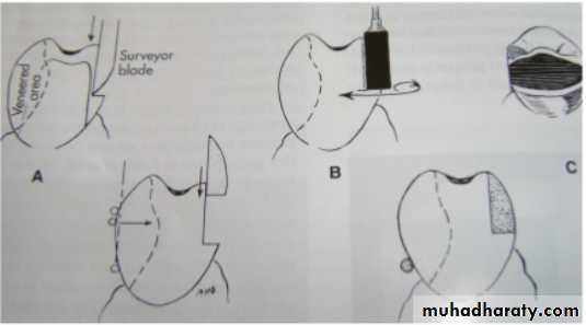 mouth preparation for removable partial denture