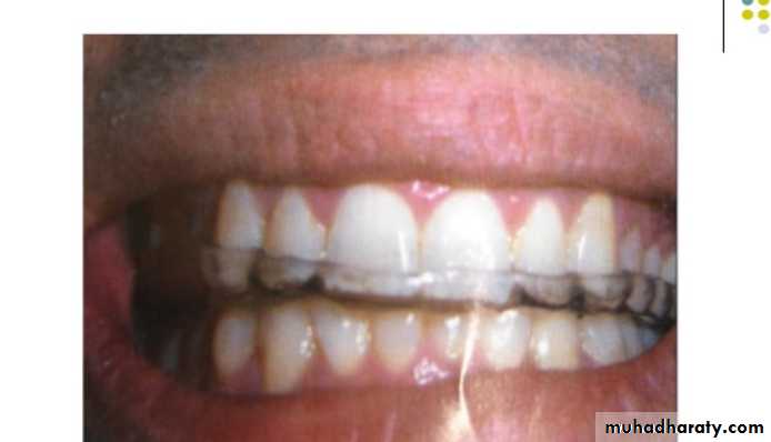 mouth preparation for removable partial denture