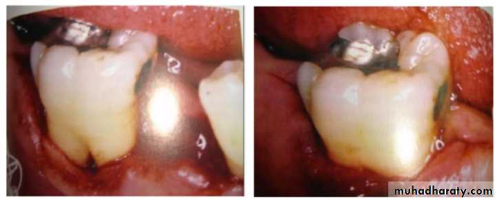 mouth preparation for removable partial denture