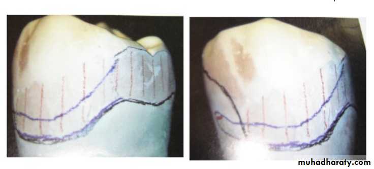mouth preparation for removable partial denture