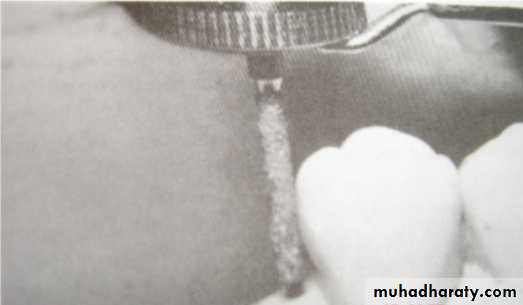mouth preparation for removable partial denture
