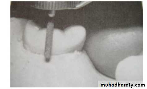 mouth preparation for removable partial denture