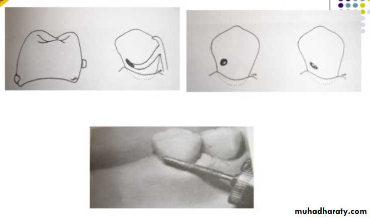 mouth preparation for removable partial denture