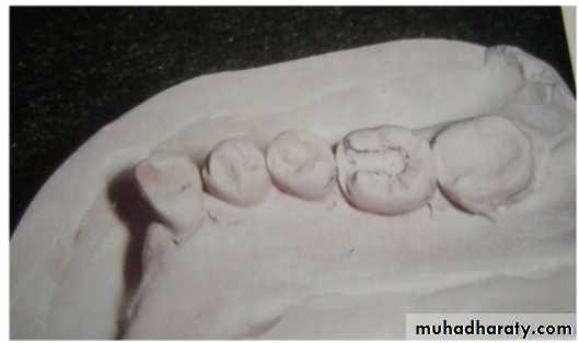 mouth preparation for removable partial denture