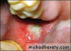 classification of periodontal disease
