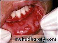 classification of periodontal disease