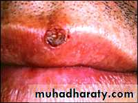 classification of periodontal disease