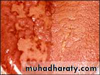classification of periodontal disease