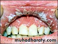 classification of periodontal disease