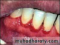 classification of periodontal disease