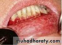 classification of periodontal disease