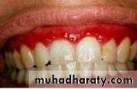classification of periodontal disease