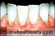 classification of periodontal disease