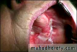 classification of periodontal disease