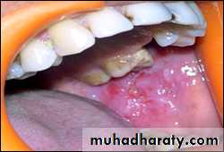 classification of periodontal disease
