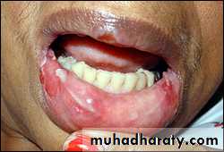 classification of periodontal disease