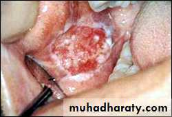 classification of periodontal disease