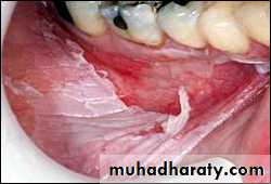 classification of periodontal disease