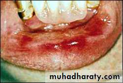 classification of periodontal disease