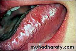 classification of periodontal disease