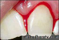 classification of periodontal disease