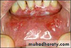 classification of periodontal disease